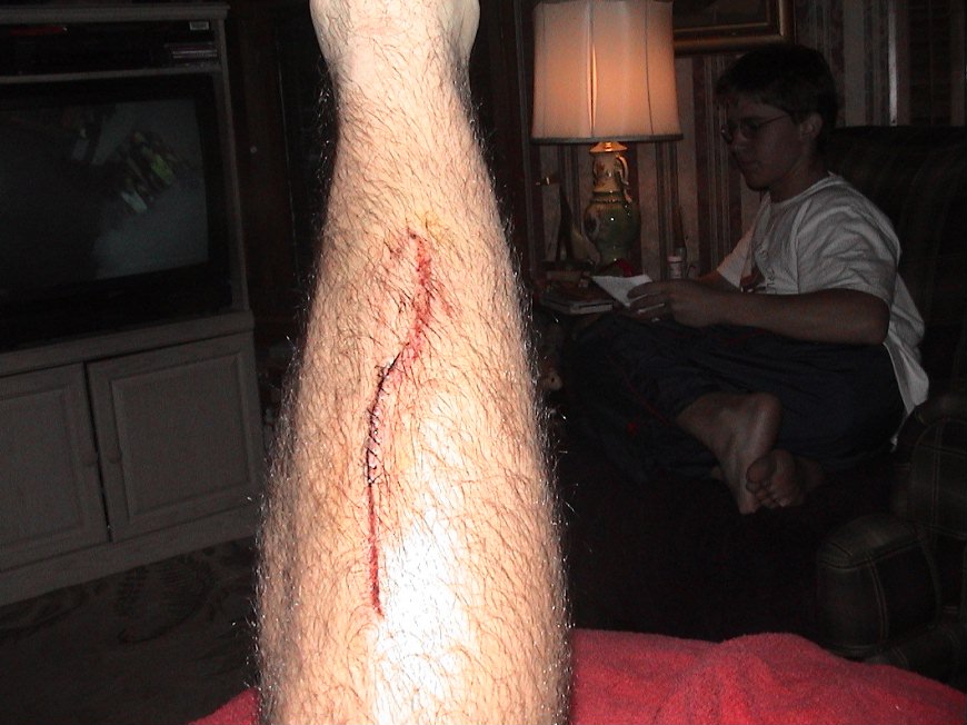 leg injury.jpg